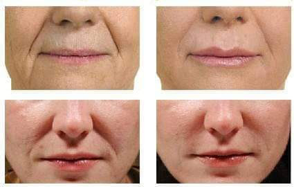 előtte utána kép, kozmetika 4