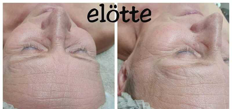 előtte utána kép, kozmetika